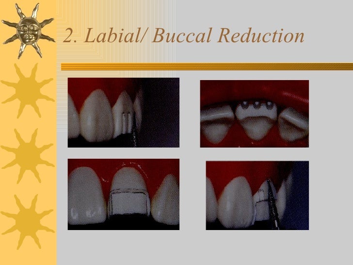 Iv.tooth prep v. occlusion