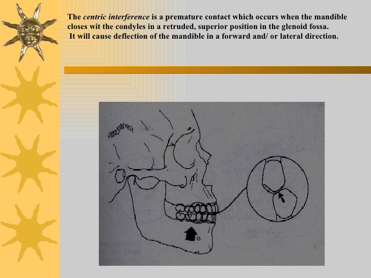 Iv.tooth prep v. occlusion