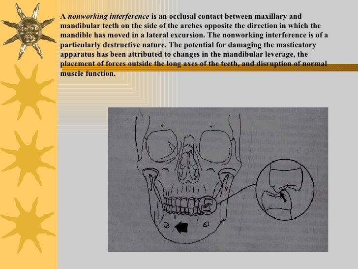 Iv.tooth prep v. occlusion