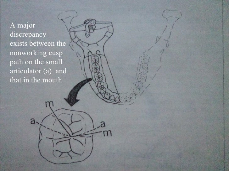 Iv.tooth prep v. occlusion