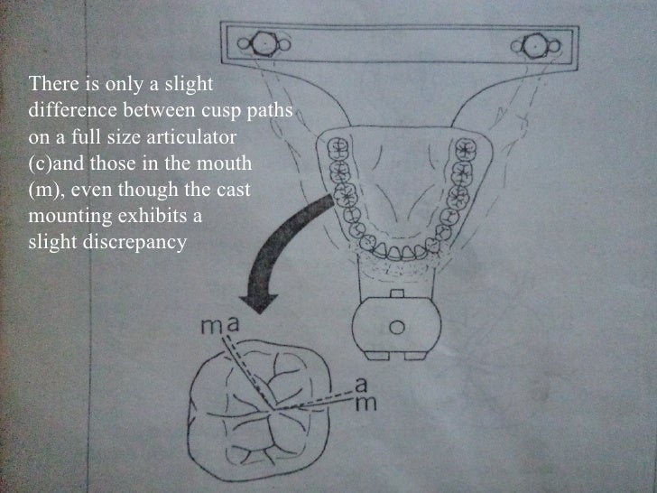 Iv.tooth prep v. occlusion