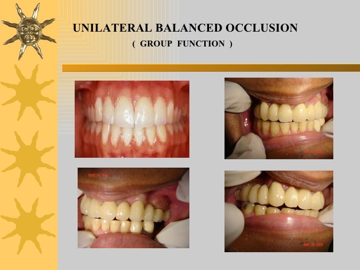 Iv.tooth prep v. occlusion