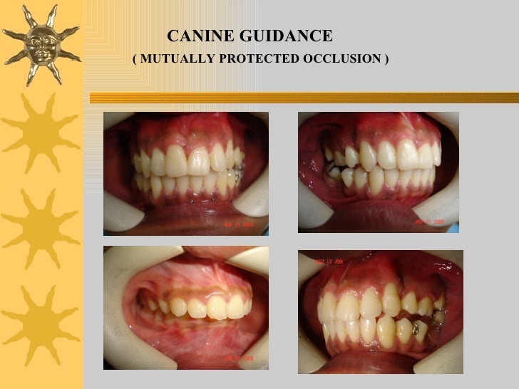 Iv.tooth prep v. occlusion