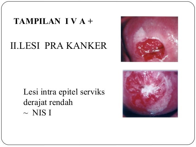 Skrining kanker cerviks dengan IVA