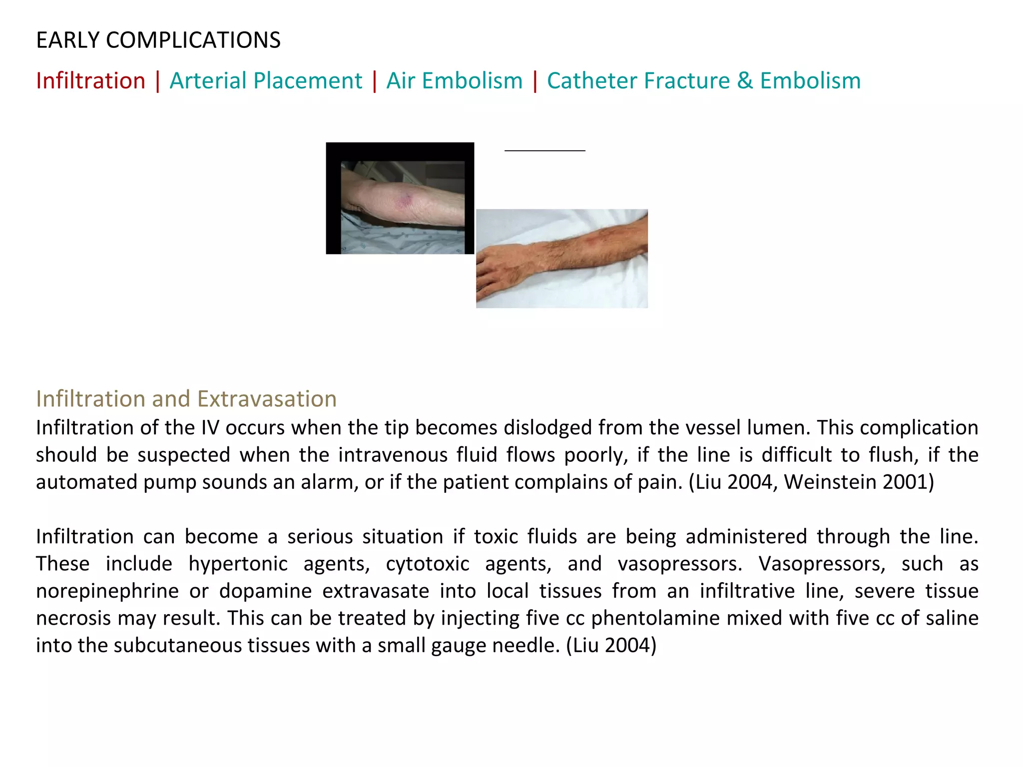 EARLY COMPLICATIONS
Infiltration | Arterial Placement | Air Embolism | Catheter Fracture & Embolism




Infiltration and Extravasation
Infiltration of the IV occurs when the tip becomes dislodged from the vessel lumen. This complication
should be suspected when the intravenous fluid flows poorly, if the line is difficult to flush, if the
automated pump sounds an alarm, or if the patient complains of pain. (Liu 2004, Weinstein 2001)

Infiltration can become a serious situation if toxic fluids are being administered through the line.
These include hypertonic agents, cytotoxic agents, and vasopressors. Vasopressors, such as
norepinephrine or dopamine extravasate into local tissues from an infiltrative line, severe tissue
necrosis may result. This can be treated by injecting five cc phentolamine mixed with five cc of saline
into the subcutaneous tissues with a small gauge needle. (Liu 2004)
 