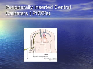 Peripherally Inserted CentralPeripherally Inserted Central
Catheters ( PICC’s)Catheters ( PICC’s)
 