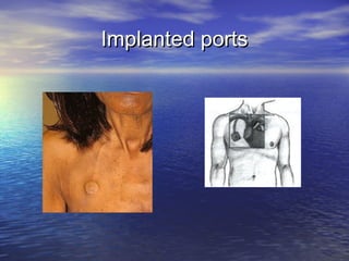 Implanted portsImplanted ports
 