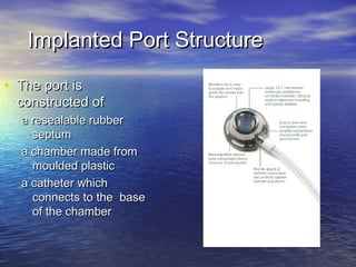 Implanted Port StructureImplanted Port Structure
• The port isThe port is
constructed ofconstructed of
a resealable rubbera resealable rubber
septumseptum
a chamber made froma chamber made from
moulded plasticmoulded plastic
a catheter whicha catheter which
connects to the baseconnects to the base
of the chamberof the chamber
 