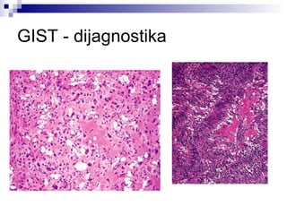 GIST - dijagnostika 