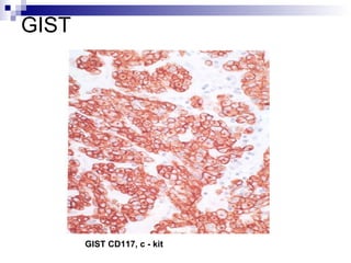 GIST  GIST  CD117, c - kit   