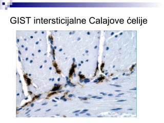 GIST intersticijalne Calajove ć 