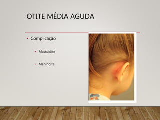 OTITE MÉDIA AGUDA
• Complicação
• Mastoidite
• Meningite
 