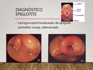 DIAGNÓSTICO
EPIGLOTITE
• Laringoscopia:Visualização da epiglote
vermelho-cereja, edemaciada.
 