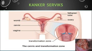 19
KANKER SERVIKS
 