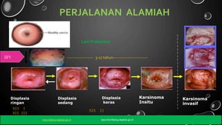 Kanke
PERJALANAN ALAMIAH
r
Lesi Prakanker
HPV ------------------- 3-17 tahun-------------------------
Karsinoma
Insitu
Displasia
keras
Displasia
ringan
Displasia
sedang
Karsinoma
invasif
NIS I
NIS III
NIS II
www.litbang.depkes.go.id ejournal.litbang.depkes.go.id
 