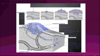 M A U , G N A N T
O r:t IN V .A S llV IE.
C A N C ER
,.,.ORMA_L
C E L L S
A B N O R M A L
CEILLS
AB NORM AI L
C E L L S M U L T I P L Y
LYM P H - --t----="'-......._C"....
VESSE L
BLrQO,D
V E S S E L
tLOCAL INVASION
A N G I O G E N E S I S
Tum.ours gr'Ow their O'Wl'i
b l o o d v e s s e l s
L Y M P H V E S S E L
M ETAST.A.SILS
Geills move- 3Wai'f fi''Clm
[Pl'irnary tumour ancl
Ii nva de other p.all"ts o f
t h e i b o d y v i a b l o o d
vessels a n d lymp h
V'li!�
:sels
 