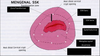 69
MENGENAL SSK
Metaplasi epitel
skuamosa
Epitel kolumnar
SSK lama
SSK baru
ZonaTransformasi
 