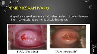 e ou na bang depkes go d
PEMERIKSAAN IVA (5)
•Lepaskan spekulum secara halus dan rendam di dalam larutan
klorin 0,5% selama 10 menit untuk desinfeksi.
j r l.lit . . .i /
 