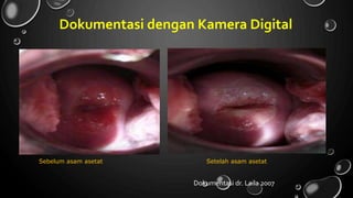 Dokumentasi dengan Kamera Digital
Sebelum asam asetat Setelah asam asetat
Dokumentasi dr. Laila 2007
 