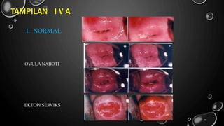 TAMPILAN I V A
I. NORMAL
OVULA NABOTI
EKTOPI SERVIKS
88
 