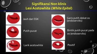 Signifikansi Non klinis
Lesi Acetowhite (White Epitel)
Garis putih dekat os
(endoserviks)
Jauh dari SSK
Bintik putih pucat
os (endoserviks)
pada
Putih pucat
Positif
Larik acetowhite
90
 