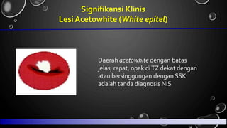 Signifikansi Klinis
Acetowhite (White epitel)
Lesi
Daerah acetowhite dengan batas
jelas, rapat, opak diTZ dekat dengan
atau bersinggungan dengan SSK
adalah tanda diagnosis NIS
 