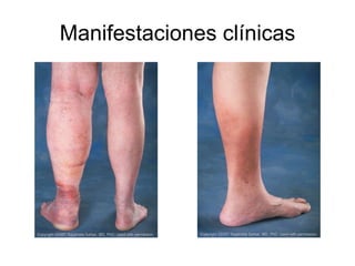 Manifestaciones clínicas 