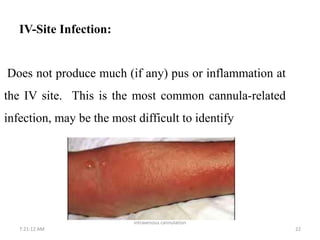 Iv Line Infection iv cannula.pptx