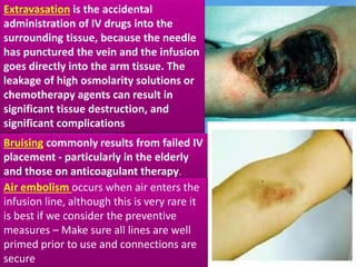 Extravasation is the accidental 
administration of IV drugs into the 
. 
surrounding tissue, because the needle 
has punctured the vein and the infusion 
goes directly into the arm tissue. The 
leakage of high osmolarity solutions or 
chemotherapy agents can result in 
significant tissue destruction, and 
significant complications 
Bruising commonly results from failed IV 
placement - particularly in the elderly 
and those on anticoagulant therapy. 
Air embolism occurs when air enters the 
infusion line, although this is very rare it 
is best if we consider the preventive 
measures – Make sure all lines are well 
primed prior to use and connections are 
secure 
 
