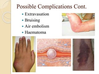 Possible Complications Cont.
 Extravasation
 Bruising
 Air embolism
 Haematoma
 