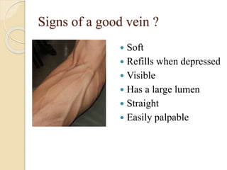 Signs of a good vein ?
 Soft
 Refills when depressed
 Visible
 Has a large lumen
 Straight
 Easily palpable
 