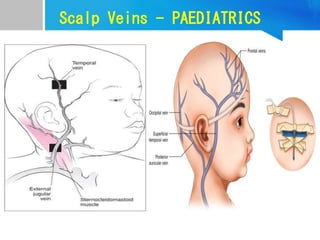 Scalp Veins - PAEDIATRICS
 