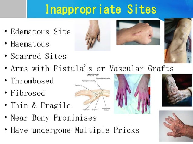 IV Cannulation.ppt | First Aid | Injuries