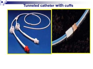 Tunneled catheter with cuffs
 
