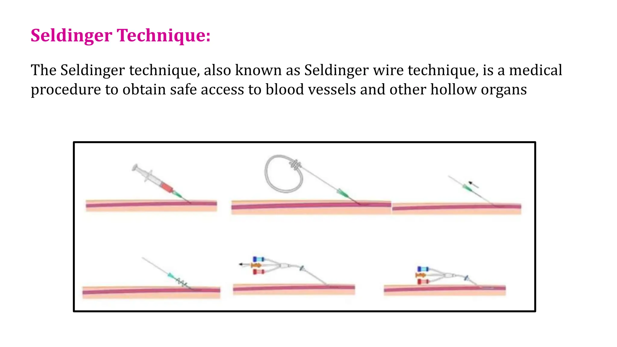 Seldinger Technique:
The Seldinger technique, also known as Seldinger wire technique, is a medical
procedure to obtain safe access to blood vessels and other hollow organs
 