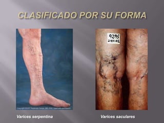 Varices serpentina   Varices saculares
 