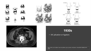 1930s
• IVC plication or ligation.
Marron Rm, et.al. Inferior vena cava filters: past, present, and future. Chest2020;158(06):2579–
2589
 