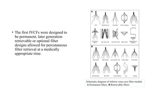 • The first IVCFs were designed to
be permanent, later generation
retrievable or optional filter
designs allowed for percutaneous
filter retrieval at a medically
appropriate time.
Schematic diagram of inferior vena cava filter models.
A Permanent filters. B Retrievable filters
 