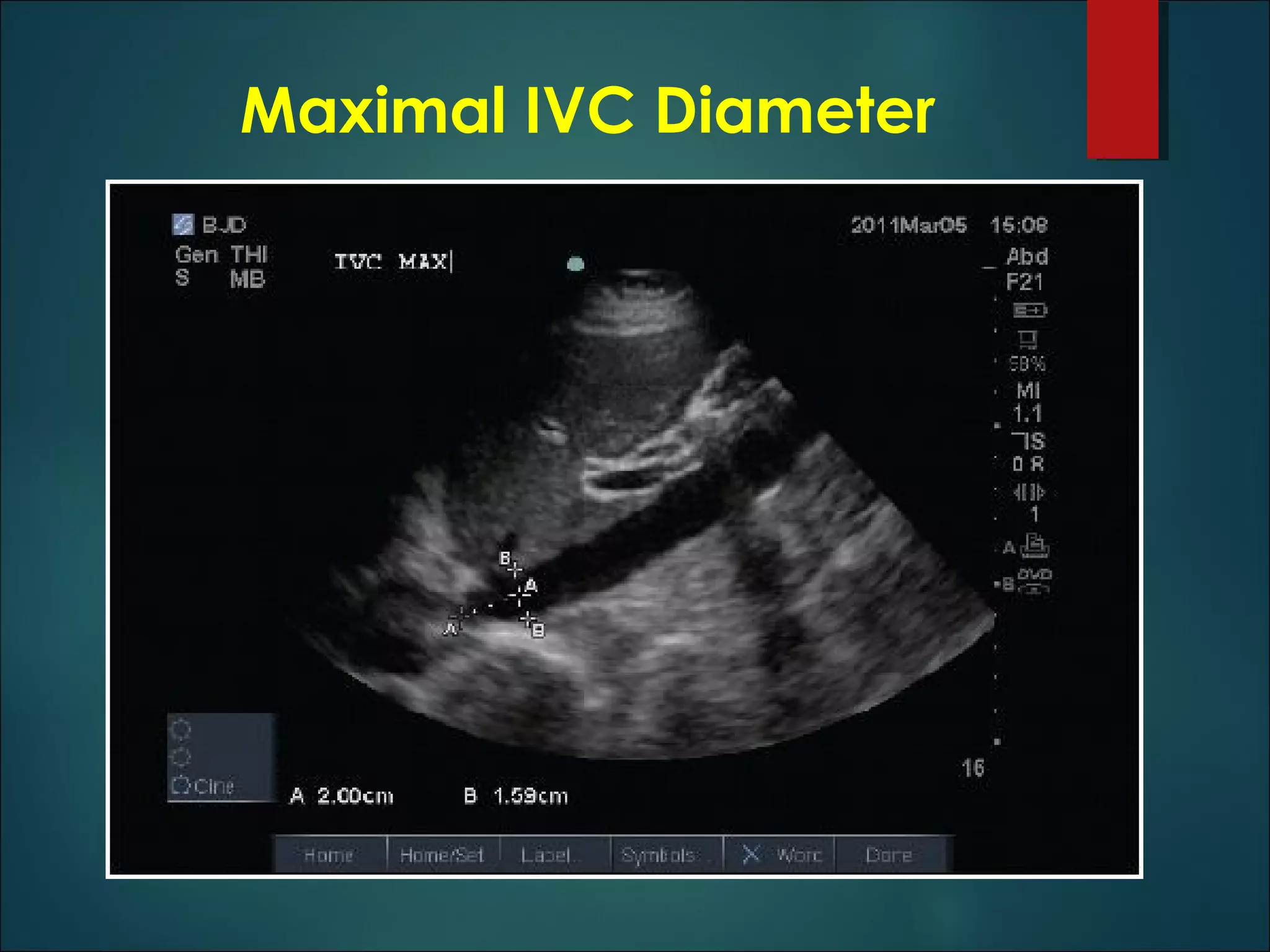 Ivc guided fluid management in the icu | PPT