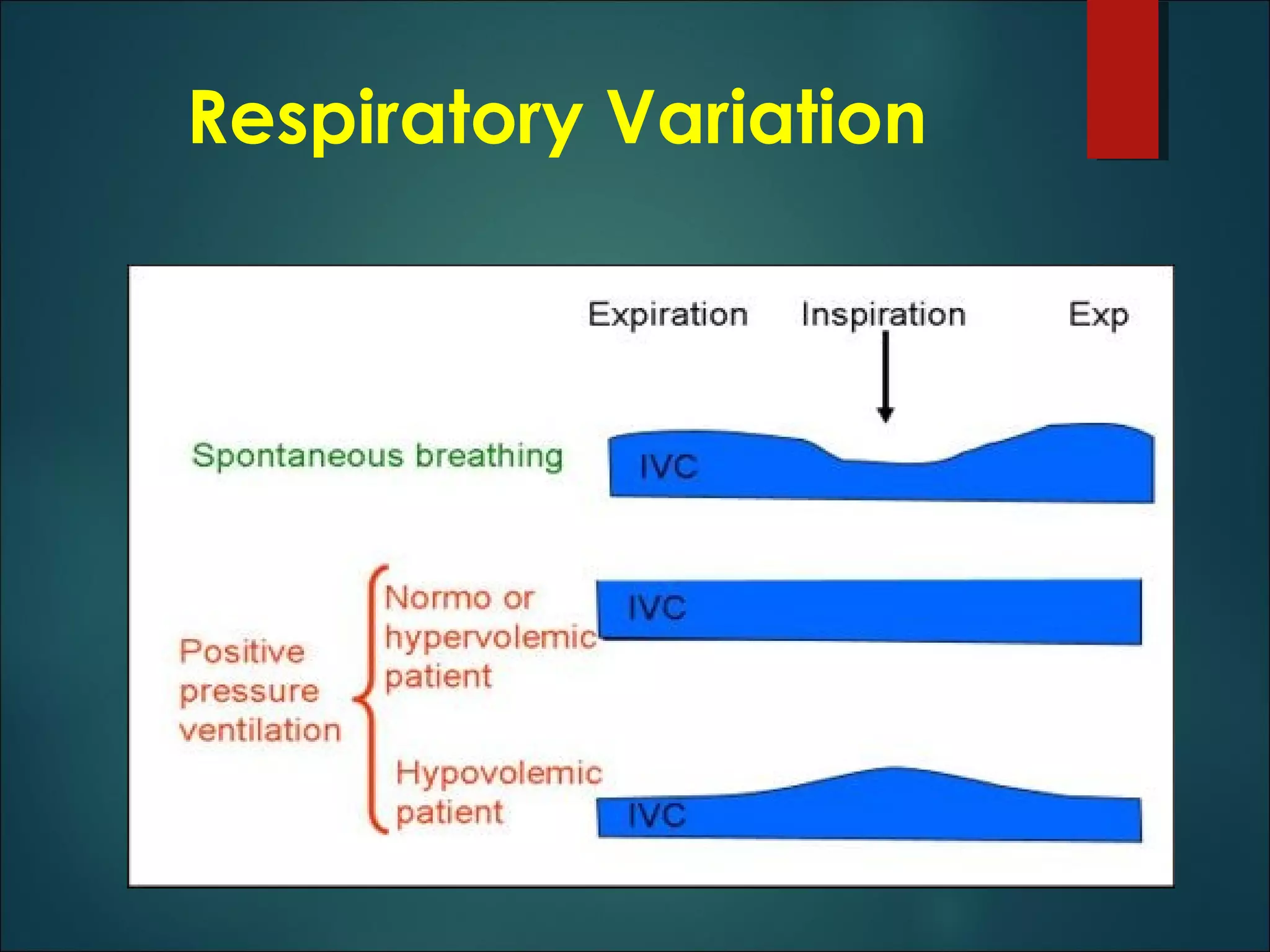 Ivc guided fluid management in the icu | PPT