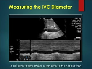 Ivc Math Ivc guided fluid management in the icu | PPT