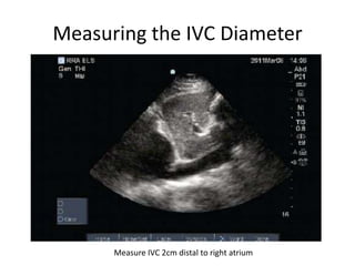 Ivc Math IVC Ultrasound | PPTX