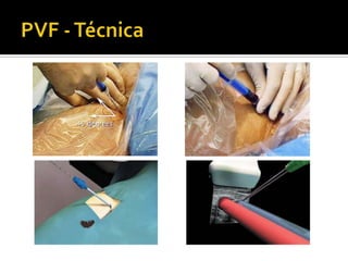 PVF - Técnica