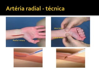 Artéria radial - técnica