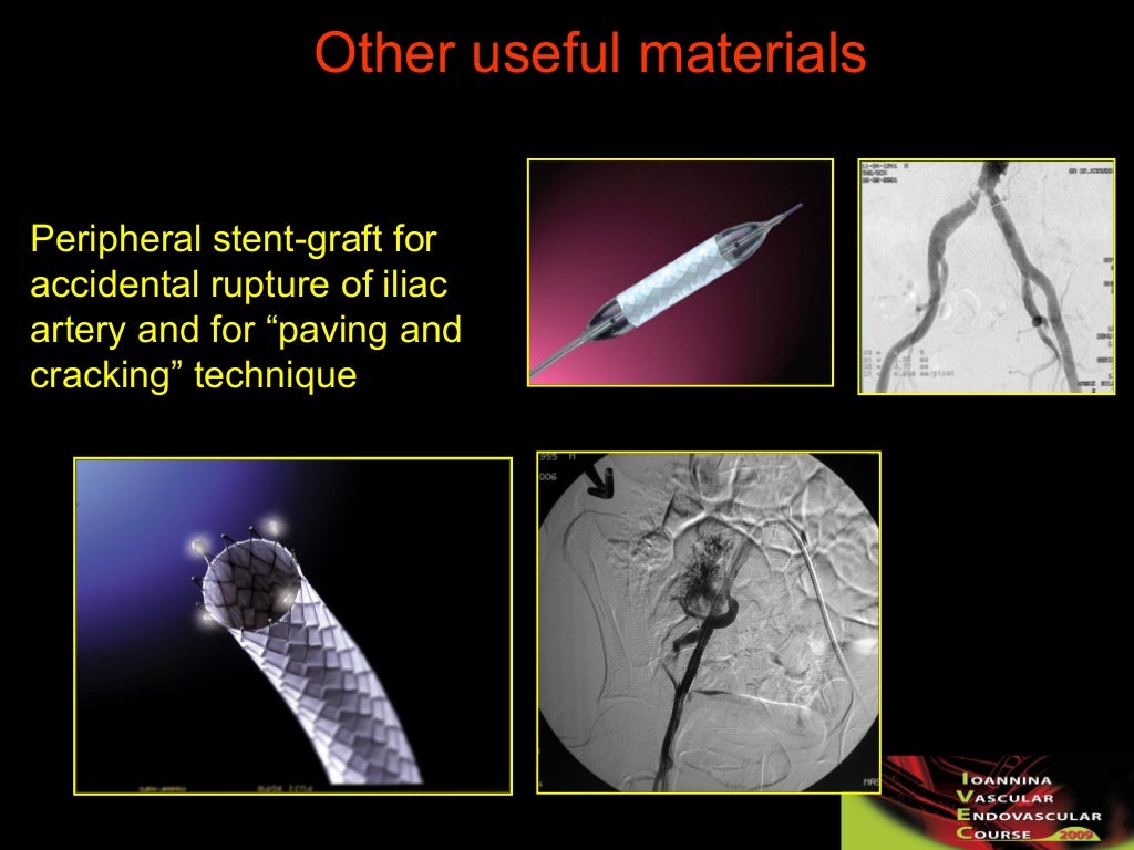 Choosing catheters & guidewires