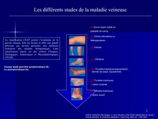 Les différents stades de la maladie veineuse C0   Aucun signe visible ou palpable de varice C1  Veines réticulaires ou télangiectasies C2  Varices C3   OEdème C4   Troubles trophiques:pigmentation,  dermite de stase, hypodermite C5  Troubles trophiques + ulcère cicatrisé C6   Troubles trophiques + ulcère ouvert Chaque stade peut être symptomatique (S)  ou asymptomatique (A) Eklöf B, Rutherford RB, Bergan JJ, et al. Revision of the CEAP classification for chronic venous disorders. A consensus statement. J Vasc Surg. 2004; 40 : 1248-1252. La classification CEAP permet l’évaluation de la gravité clinique. Elle est récente et offre une grande précision qui devrait permettre une meilleure évaluation des résultats thérapeutiques. Cette classification repose sur des critères Cliniques, Étiologiques, Anatomiques et Physiopathologiques (CEAP). 