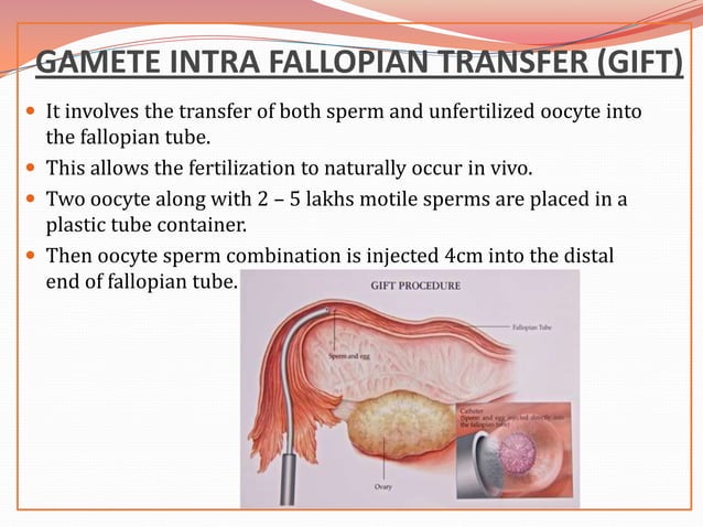 In Vitro Fertilization PPT