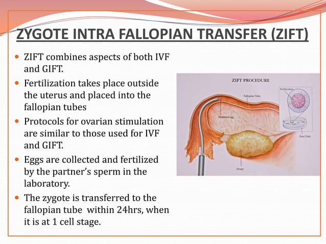 In Vitro Fertilization PPT