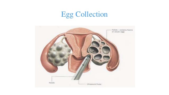 8 retrieved eggs ivf Ivf 8 retrieved eggs ivf Ivf