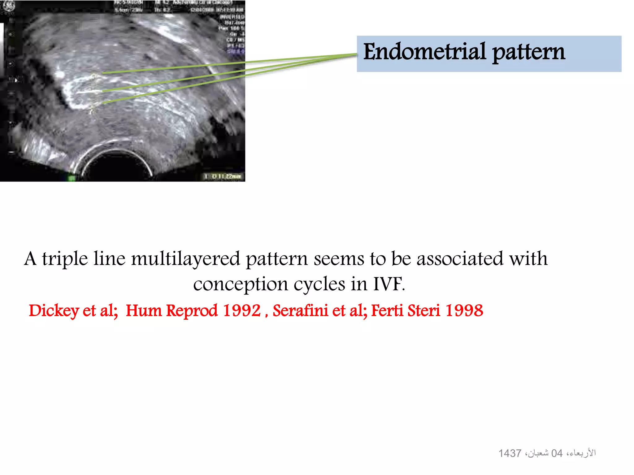 Endometrial pattern
،األربعاء04،شعبان1437
A triple line multilayered pattern seems to be associated with
conception cycles in IVF.
Dickey et al; Hum Reprod 1992 , Serafini et al; Ferti Steri 1998